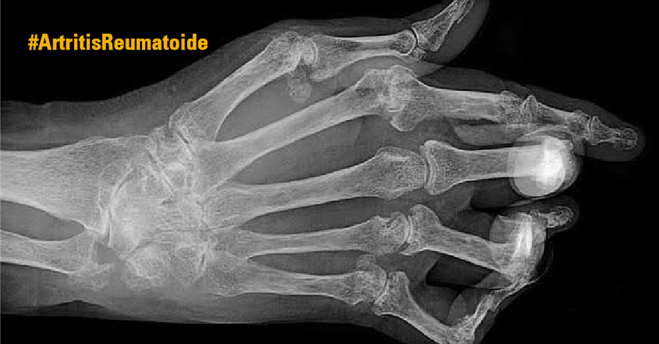Cómo prevenir la artritis reumatoide: Higiene bucodental